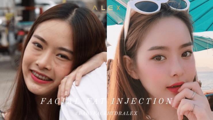 รีวิวฉีดไขมันหน้าเด็ก (Facial Fat Injection) – Real Patient