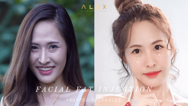 ฉีดไขมันหน้าเด็กกับคุณหมออเล็กซ์ดียังไง…มาดูกัน :)