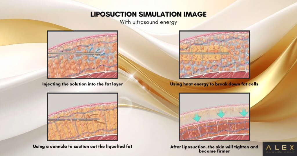 How to perform liposuction
