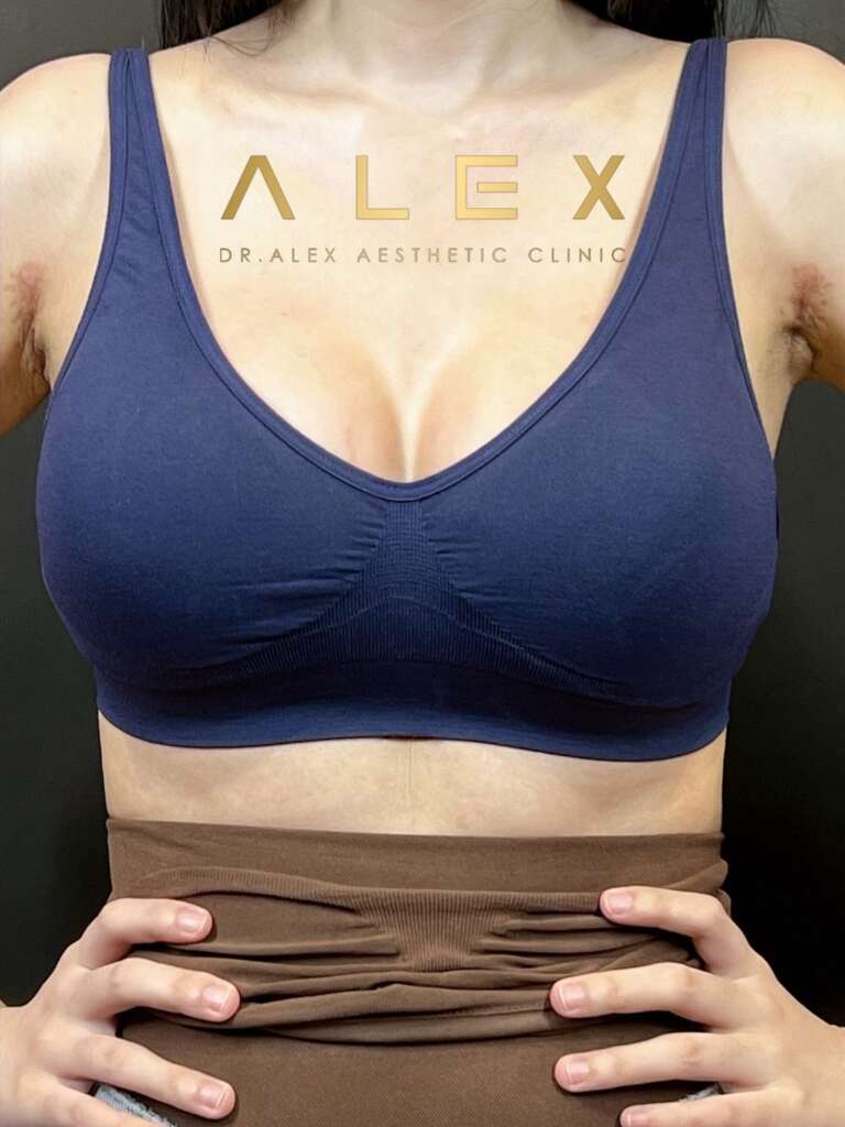 รีวิวเสริมหน้าอก Dr. Alex