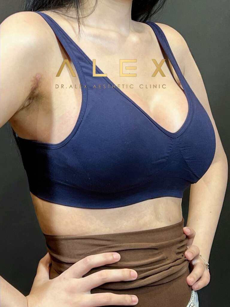 รีวิวเสริมหน้าอก Dr. Alex