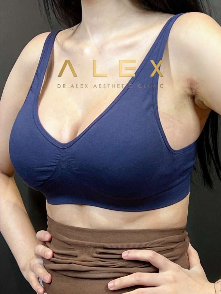 รีวิวเสริมหน้าอก Dr. Alex