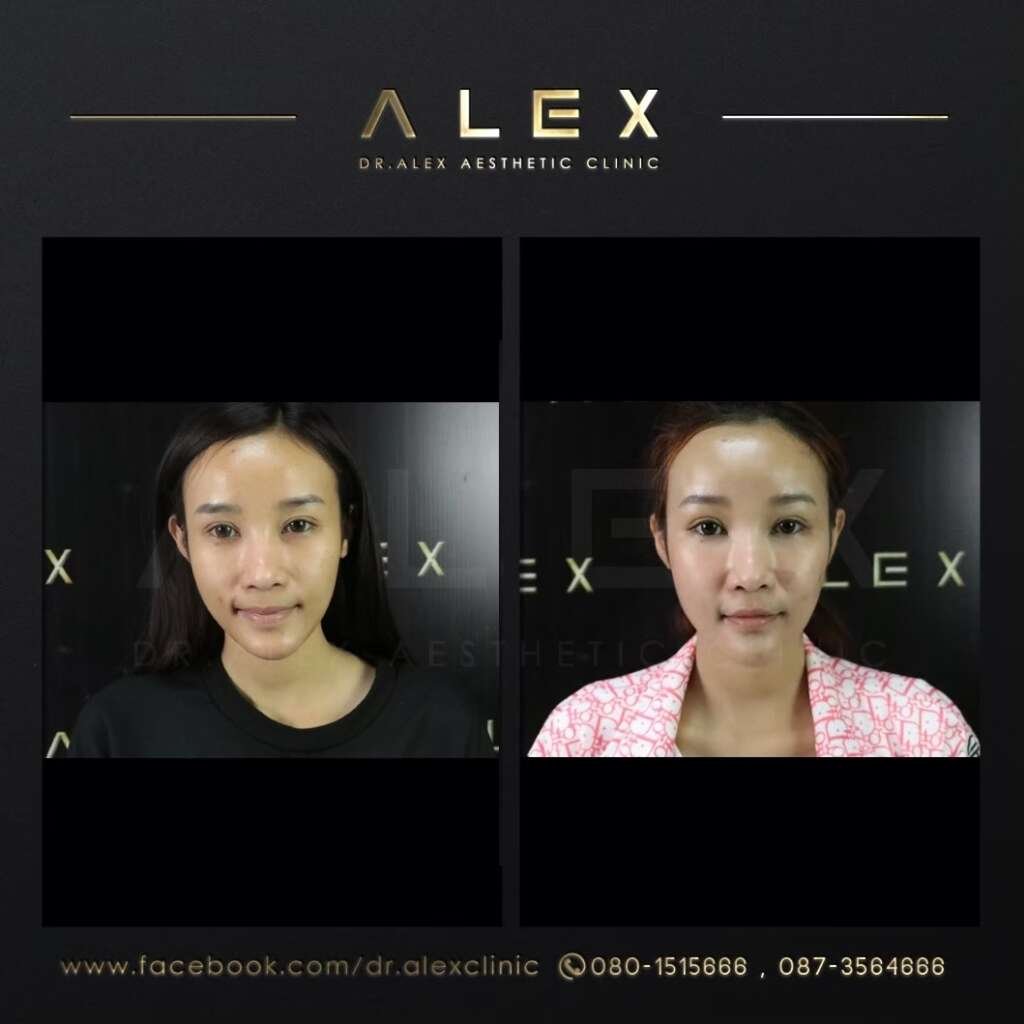 รีวิวเติมไขมันหน้าเด็กปรับรูปหน้าผากโหนกนูนปรับหน้าหวานละมุนดูอิ่มฟูสุขภาพดีอย่างธรรมชาติ Dr Alex Clinic