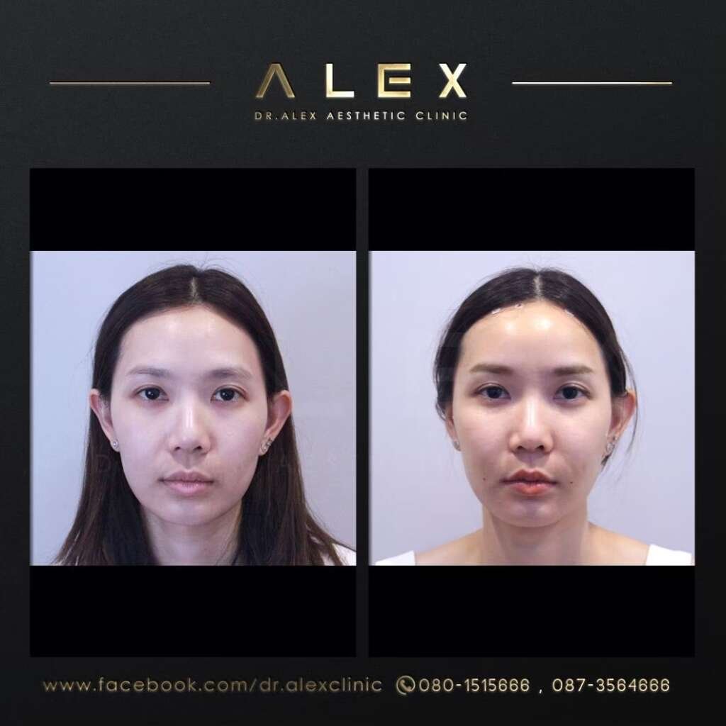 เติมไขมันหน้าเด็ก แก้ปัญหาแก้มตอบขมับยุบใต้ตาลึกปรับหน้าละมุนอิ่มฟูดูอ่อนเยาว์ Dr Alex Clinic