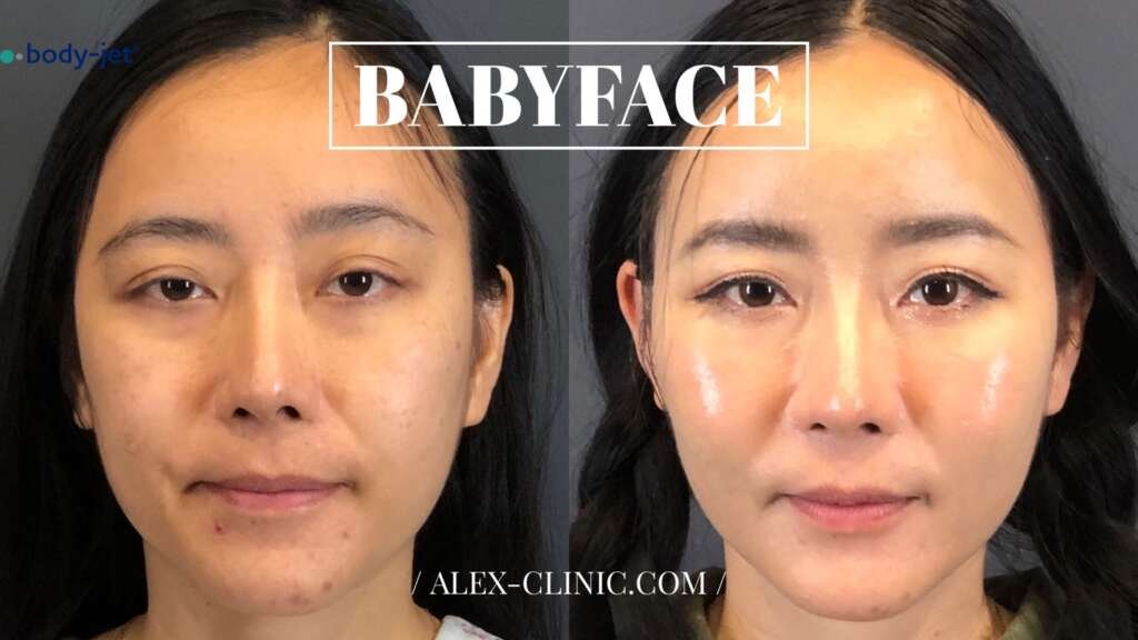 รีวิวเติมไขมันหน้าเด็กด้วยเทคนิคดูดไขมันพลังน้ำ Body Jet ฟื้นฟูผิวโกลว์ใสหน้าอิ่มฟูสุขภาพดีอย่างธรรมชาติ