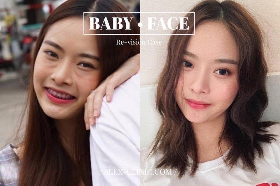 เติมไขมันหน้าเด็ก ปรับรูปหน้าเติมไขมันหน้าเด็กเคสรีวิวิชั่นปรับหน้าเบี้ยวไม่เท่ากันให้หน้าอิ่มฟูดูสมมาตร