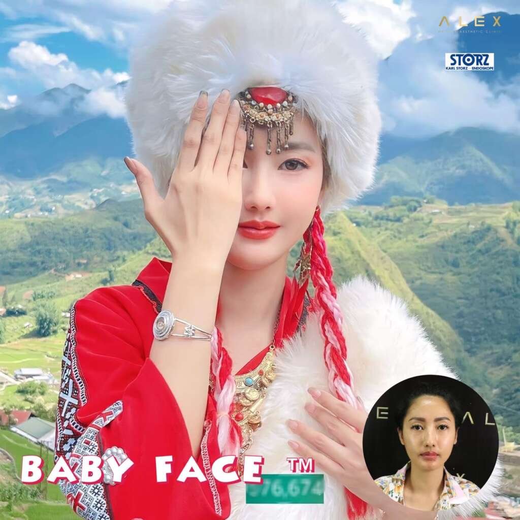 ฉีดไขมันเติมไขมันหน้าเด็กดีไซน์หน้าผากมีมิติปรับรูปหน้าสวยคมหน้าอิ่มฟูสุขภาพดีอย่างธรรมชาติ