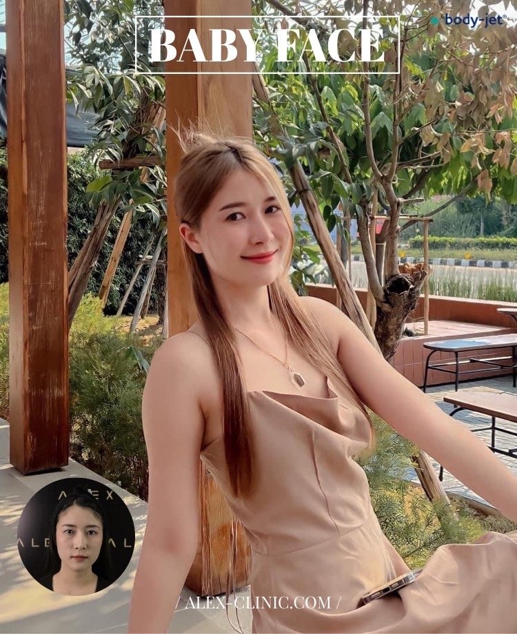 รีวิวเติมไขมันหน้าเด็กเทคนิคดูดไขมันพลังน้ำ Body-Jet ปรับหน้าอิ่มฟูดูหน้าเด็กสุขภาพดีอย่างธรรมชาติ