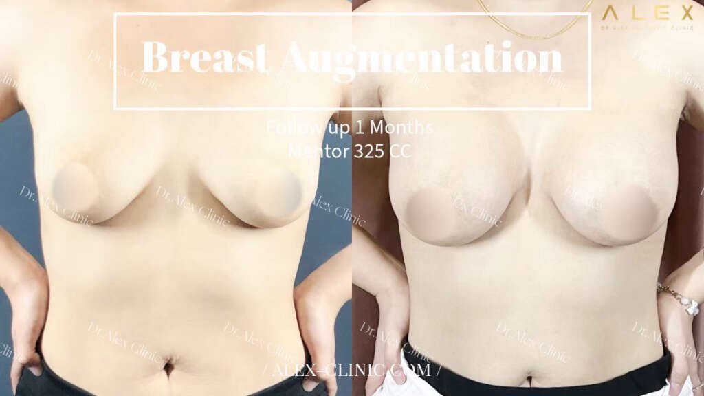 รีวิวเสริมหน้าอก ทรงธรรมชาติ สำหรับสาวตัวเล็กเนื้อนมน้อย