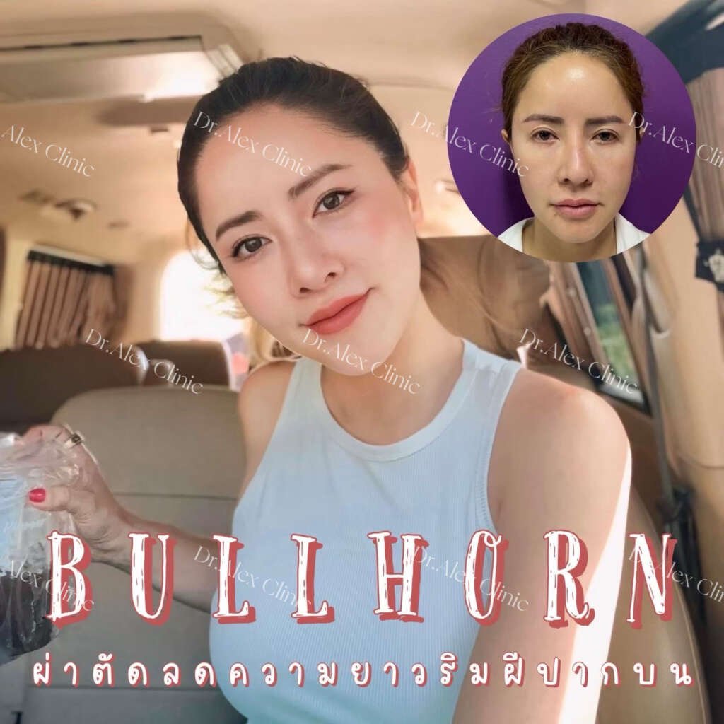 ยกริมฝีปากบน รีวิวสัดส่วนใบหน้าด้านข้าง ก่อนและหลังทำผ่าตัดยกริมฝีปากบน