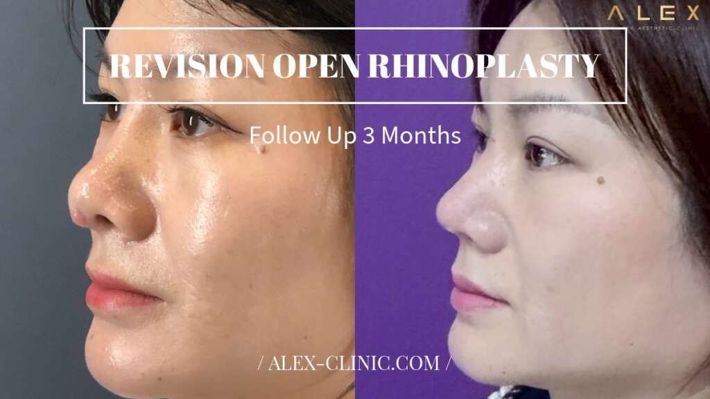 รีวิวแก้จมูกทะลุ ปรับโครงสร้างแบบ Open Rhinoplasty หลังทำ 3 เดือน ALEX Clinic