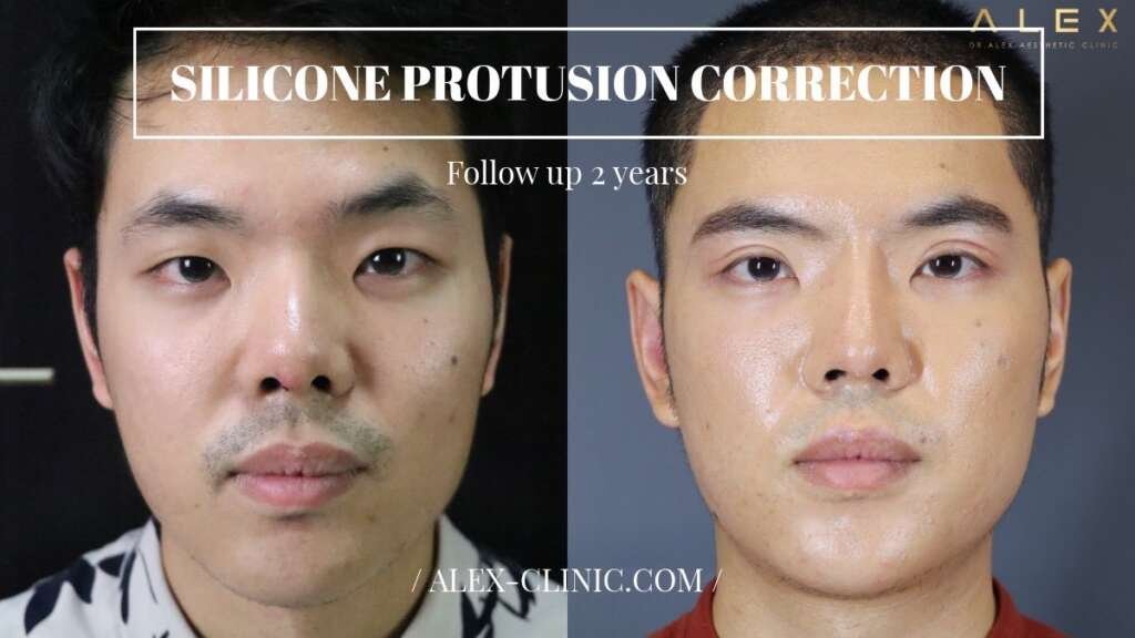 รีวิวแก้จมูกทะลุ ซิลิโคนทะลุปลายจมูก ด้านหน้า ติดตามผล 2 ปี ALEX Clinic