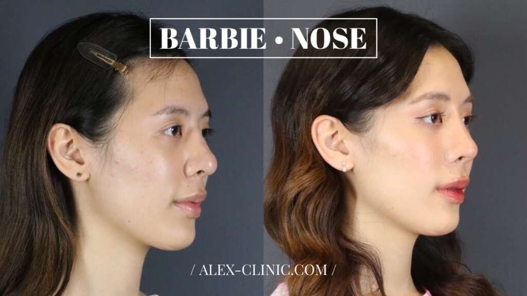 ภาพก่อนและหลัง เคสแก้ฐานจมูก ฮัมพ์ใหญ่ ปรับทรง Barbie Nose โดย Alex Clinic