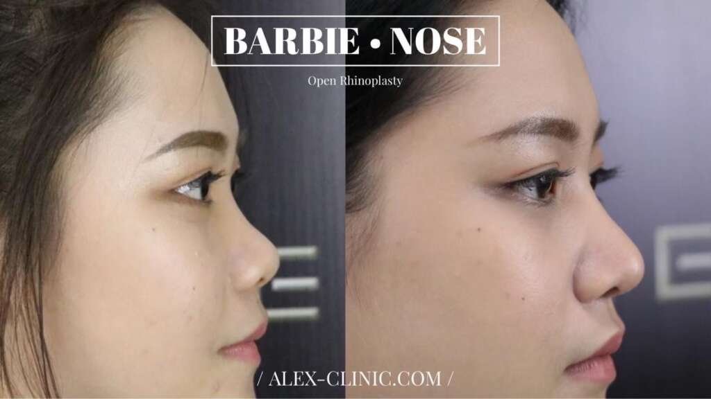 รีวิวเสริมจมูกเทคนิค Open Rhinoplasty ทรง Barbie Nose เคสเนื้อน้อย ปรับทรงสวย รับกับใบหน้า สวยธรรมชาติ จาก Alex Clinic