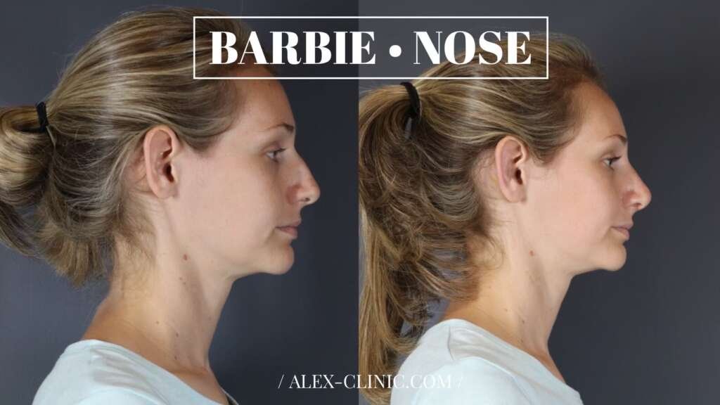 รีวิวแก้ฐานจมูกกว้าง ตะไบฮัมพ์ ปรับทรง Barbie Nose สโลปปลายพุ่ง ALEX Clinic