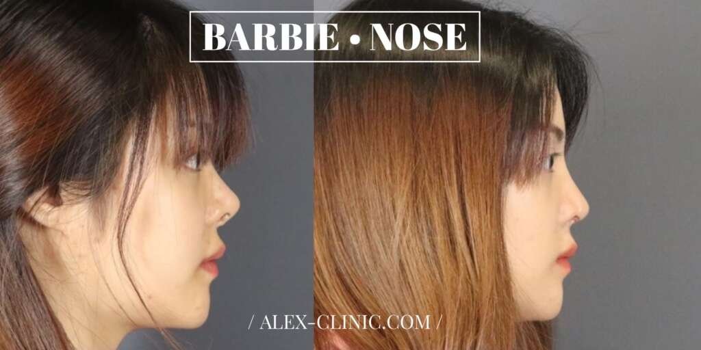 รีวิวเสริมจมูก Barbie Nose เคสเนื้อน้อย ปรับแก้ปลายเชิ่ดให้เป็นทรงหยดน้ำ รับกับใบหน้าให้หวานขึ้น สวยธรรมชาติ โดย Alex Clinic