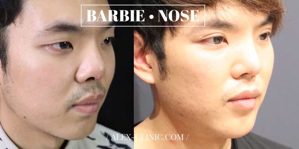 ภาพแก้จมูกทะลุ ปรับทรง Barbie Nose สโลปปลายพุ่ง ALEX Clinic
