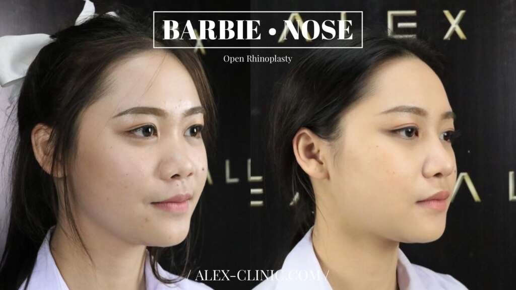 รีวิวเสริมจมูก Barbie Nose Open Rhinoplasty เคสเนื้อน้อย ปรับสวยละมุน รับกับใบหน้า สวยธรรมชาติ เหมาะกับวัยมัธยม จาก Alex Clinic