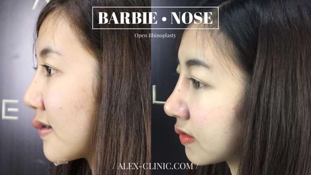 รีวิวเสริมจมูก Open Rhinoplasty ทรง Barbie Nose เคสเนื้อน้อย ปรับทรงจมูกให้ชัดขึ้น รับกับใบหน้า สวย เด่น อย่างมีมิติ จาก Alex Clinic