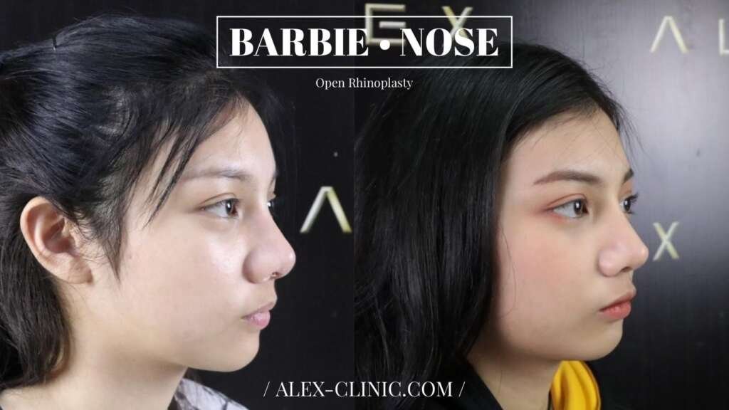รีวิวเสริมจมูก Open Rhinoplasty ทรง Barbie Nose เคสเนื้อน้อย ปรับทรงจมูกเชิ่ด รับกับใบหน้าสายฝอแต่ยังดูละมุน หน้าไม่ดุ จาก Alex Clinic