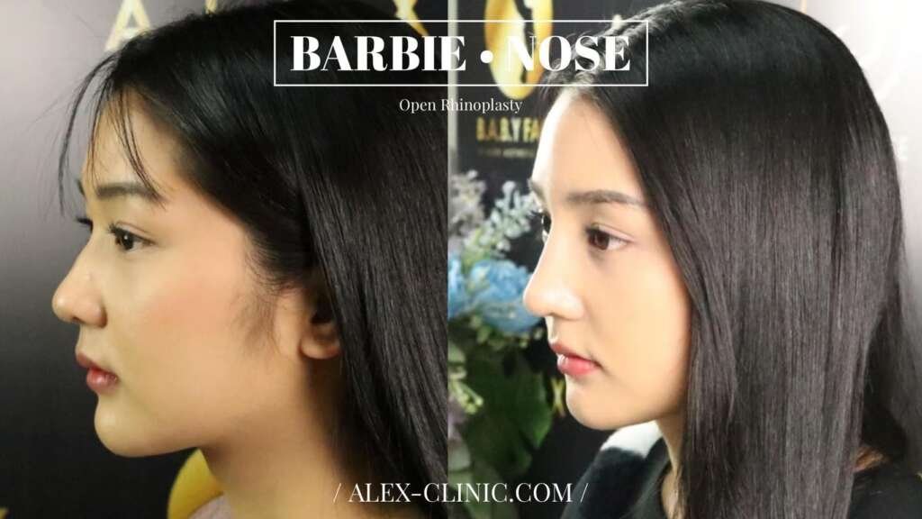 รีวิวเสริมจมูก Open Rhinoplasty ทรง Barbie Nose เคสเนื้อน้อย ปรับทรงหยดน้ำ รับกับใบหน้าสวย หวานละมุน ลุคคุณหนู จาก Alex Clinic