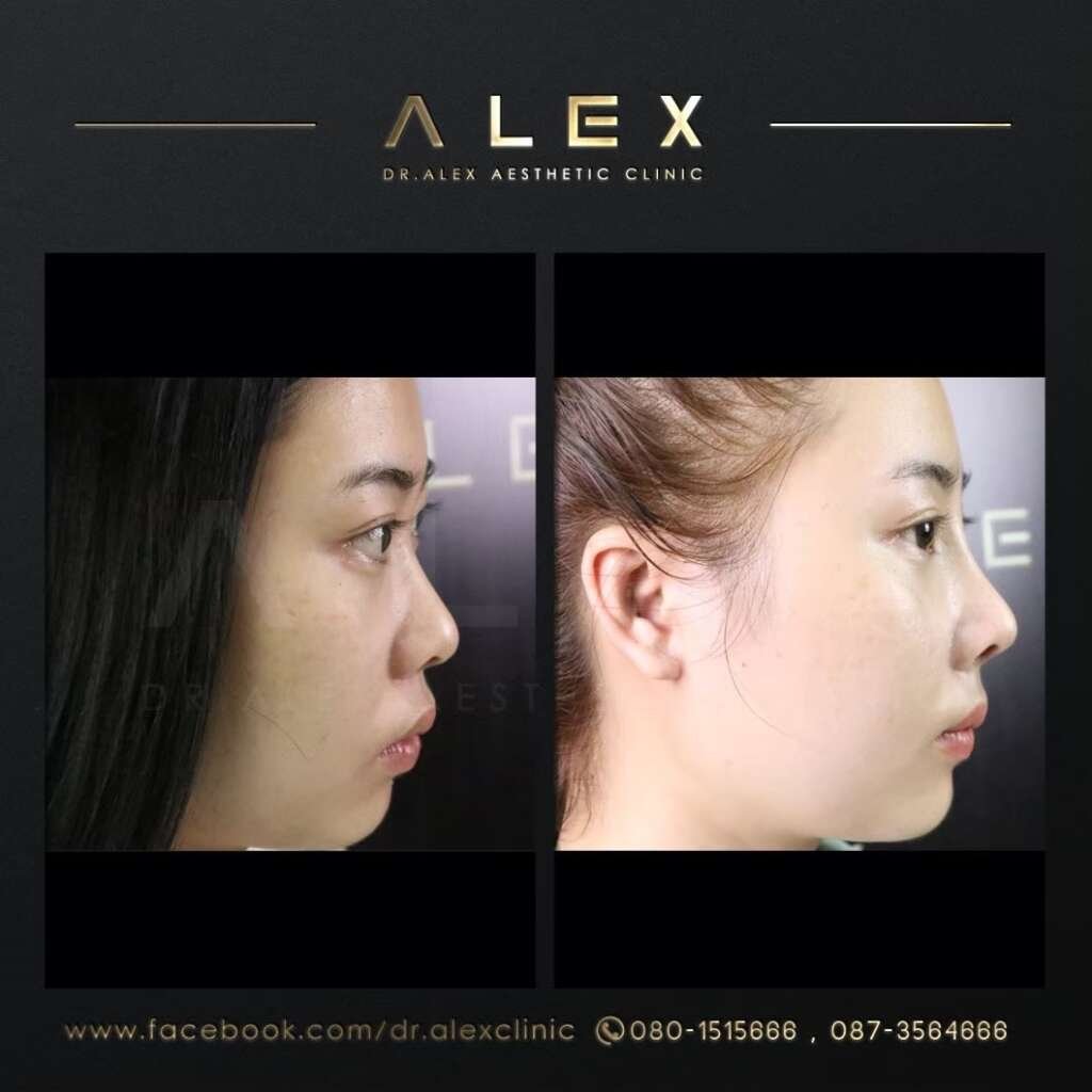 รีวิวเสริมจมูก Dr. Alex Aesthetic Clinic เคสเนื้อน้อย ปรับทรงหยดน้ำ ปลายเชิ่ดเล็กน้อย รับกับใบหน้าให้ลุคสาวอินเตอร์แบบเอเชีย