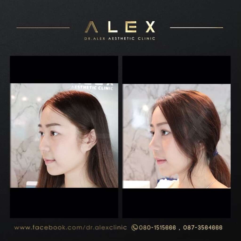 รีวิวเสริมจมูก Dr. Alex Aesthetic Clinic เคสเนื้อน้อย ปรับทรงหยดน้ำ รับกับใบหน้าให้สวยละมุน แต่หน้าคมชัด