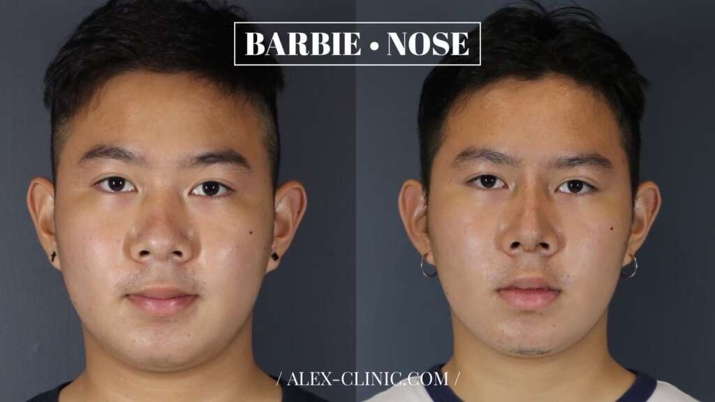 รีวิวแก้ฐานจมูกกว้าง ตอกฐานกระดูก Osteotomy ปรับสันจมูกเรียว ALEX Clinic