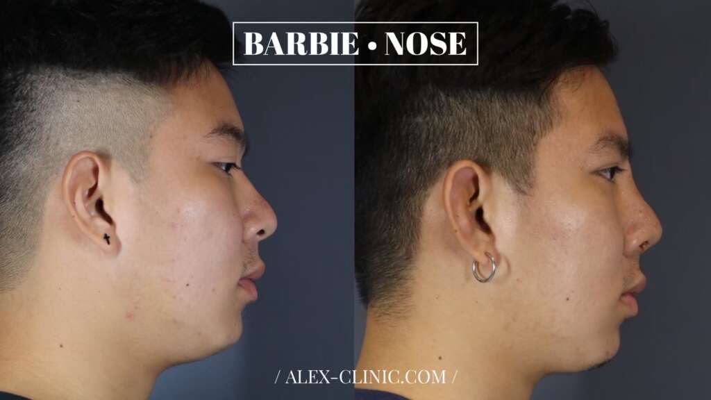 รีวิวแก้ฮัมพ์ใหญ่ ตะไบฮัมพ์ ปรับสันสโลปทรง Barbie Nose ALEX Clinic