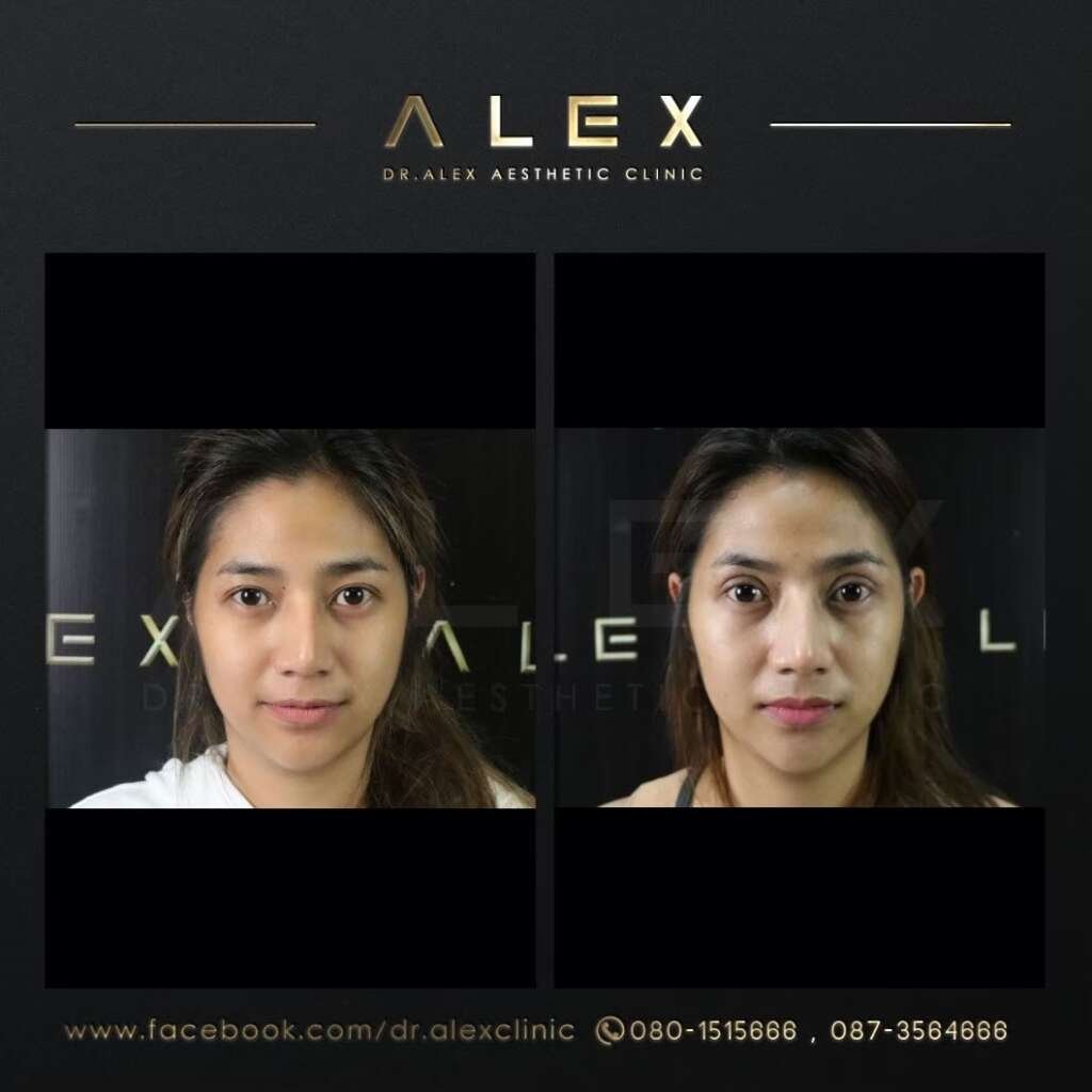 รีวิวทำตาสองชั้น เทคนิคกรีดสั้น ภาพเปรียบเทียบก่อนและหลังทำ โดย Dr. Alex Clinic