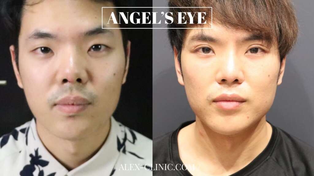 รีวิวทำตาสองชั้นผู้ชาย เทคนิคกรีดสั้น Angel's Eye เคสที่ 7