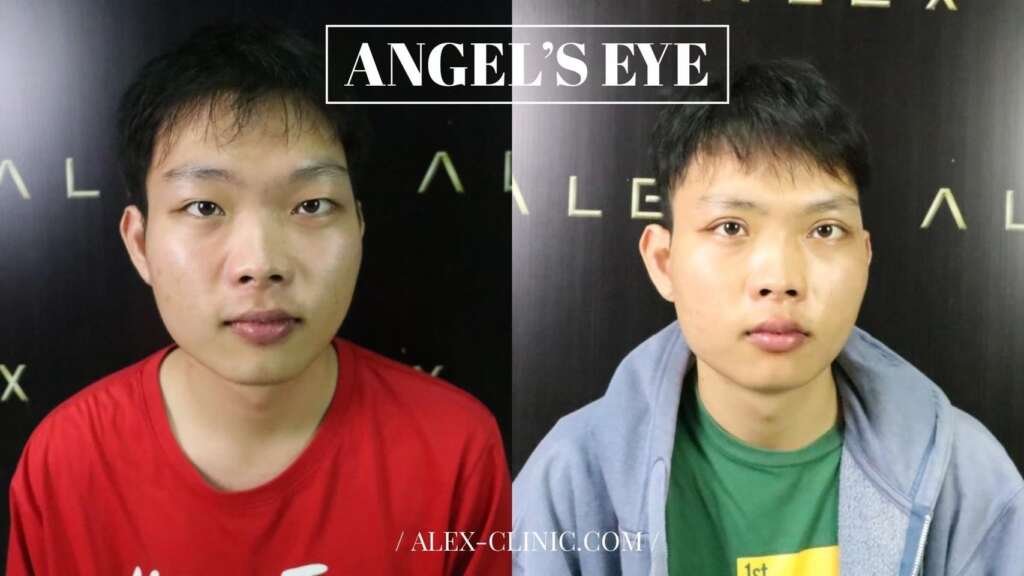 ภาพเปรียบเทียบจาก รีวิวทำตาสองชั้นผู้ชาย เทคนิค Angel's Eye