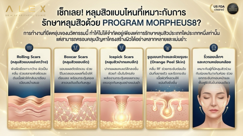 ประเภทหลุมสิวที่เหมาะกับการรักษาหลุมสิวด้วย Program Morpheus8 ได้แก่ Rolling Scars, Boxcar Scars และ Icepick Scars