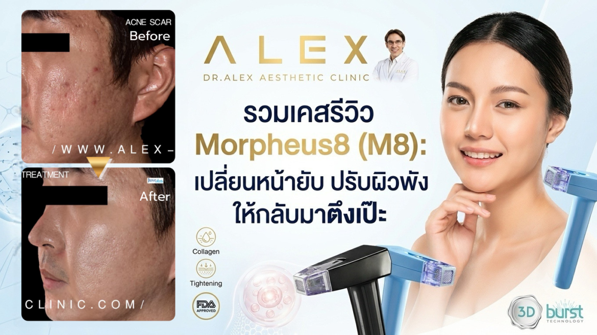 รวมเคสรีวิว Morpheus8 (M8): เปลี่ยนหน้ายับ ปรับผิวพัง ให้กลับมาตึงเป๊ะที่ Dr.Alex Clinic