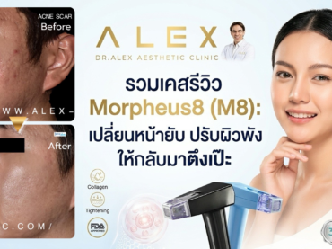 รวมเคสรีวิว Morpheus8 (M8): เปลี่ยนหน้ายับ ปรับผิวพัง ให้กลับมาตึงเป๊ะที่ Dr.Alex Clinic
