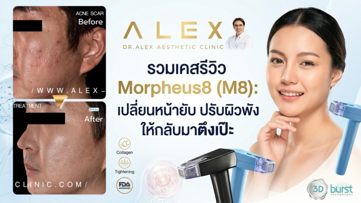 รวมเคสรีวิว Morpheus8 (M8): เปลี่ยนหน้ายับ ปรับผิวพัง ให้กลับมาตึงเป๊ะที่ Dr.Alex Clinic