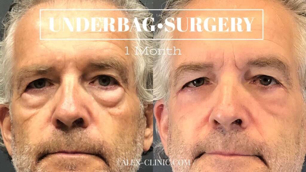 รีวิว ผ่าตัดถุงใต้ตา 1 เดือน แก้ปัญหาถุงใต้ตาใหญ่ Dr. Alex Clinic