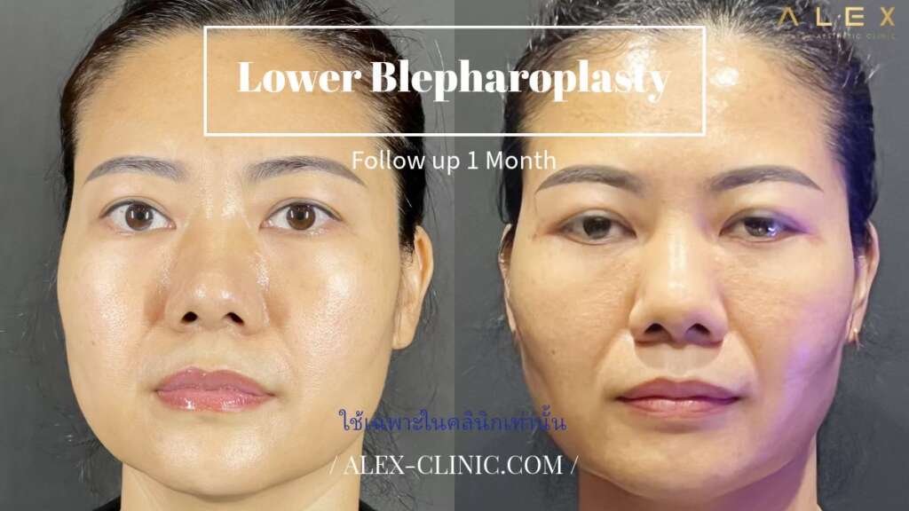 ภาพเปรียบเทียบก่อนและหลังผ่าตัดถุงใต้ตา Lower Blepharoplasty ติดตามผล 1 เดือน ที่ Dr. Alex Clinic