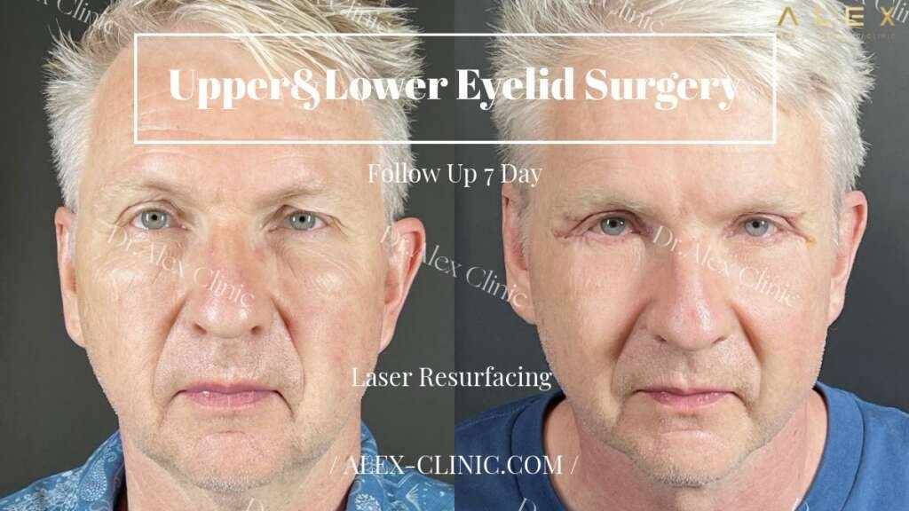 ภาพเปรียบเทียบก่อนและหลังผ่าตัดถุงใต้ตา ทำตาสองชั้น ร่วมกับ Laser Resurfacing ติดตามผล 7 วัน ที่ Dr. Alex Clinic