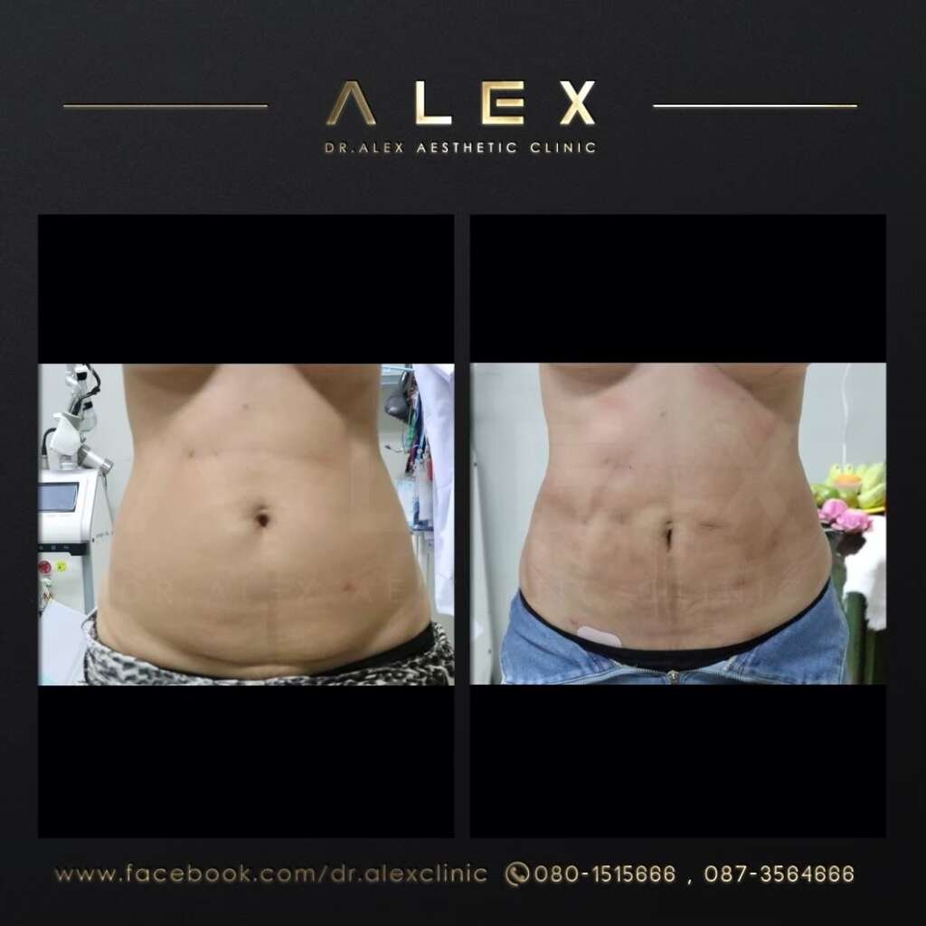 ดูดไขมันหน้าท้อง รีวิว Dr. Alex Clinic ภาพเปรียบเทียบก่อนและหลังทำ หน้าท้องแบนราบ เอวเอสชัดเจน