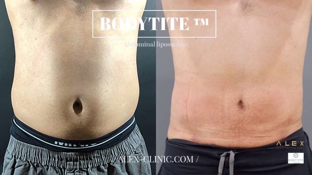 ดูดไขมันหน้าท้อง Dr. Alex Clinic ด้วยเทคโนโลยี BodyTite ภาพเปรียบเทียบก่อนและหลังทำในผู้ชาย