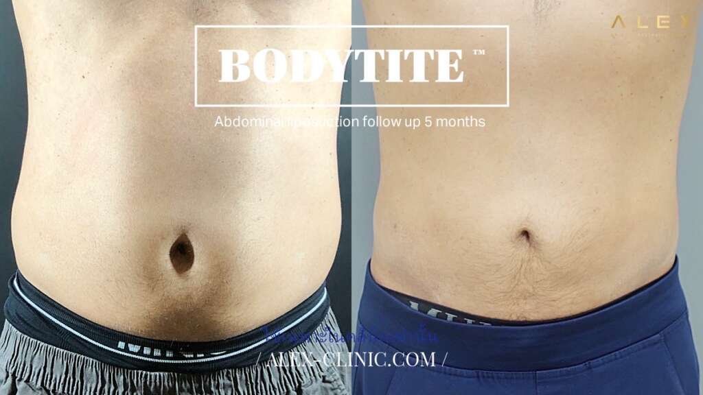 ดูดไขมันหน้าท้อง BodyTite กระชับสัดส่วน ติดตามผล 5 เดือน ALEX Clinic