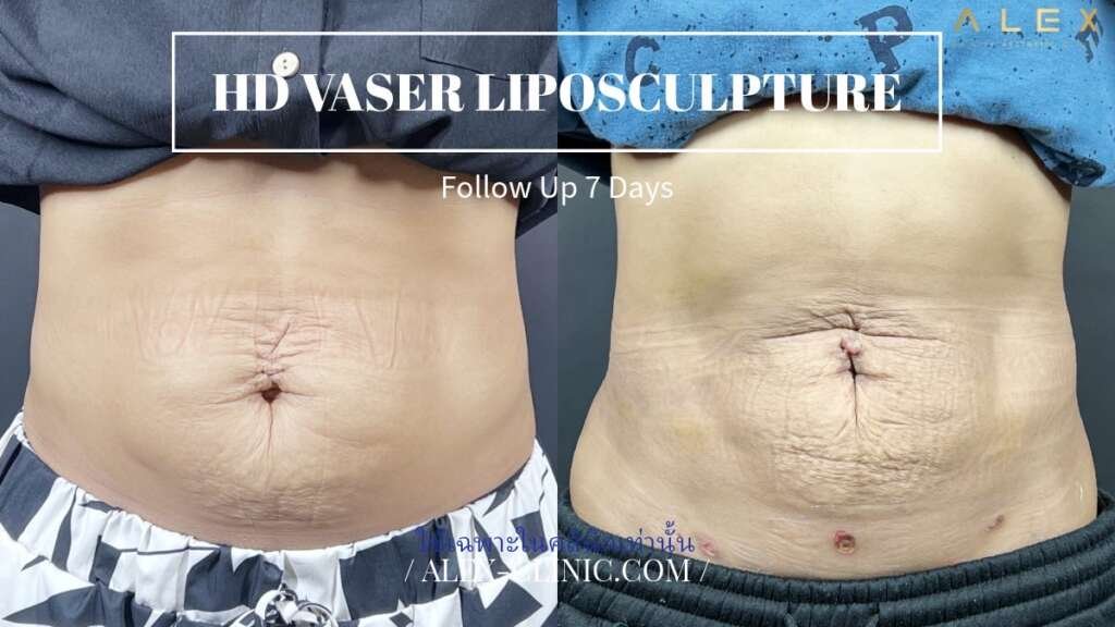 ผลลัพธ์ดูดไขมัน Vaser หน้าท้อง เทคนิค HD Vaser Liposculpture ติดตามผล 7 วัน ALEX Clinic