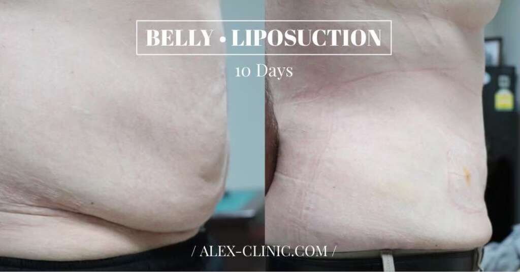 ดูดไขมันหน้าท้อง เปรียบเทียบก่อนและหลังทำ 10 วัน ALEX Clinic