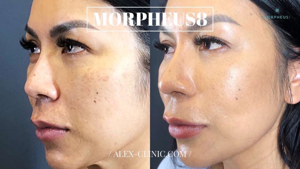 ภาพเปรียบเทียบก่อนหลังทำ Morpheus8 (M8) ลดเลือนริ้วรอย Dr.Alex Clinic