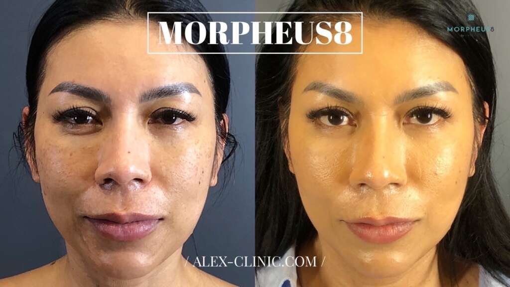 ภาพเปรียบเทียบก่อนและหลังทำ Morpheus8 (M8) ยกกระชับใบหน้า Dr.Alex Clinic