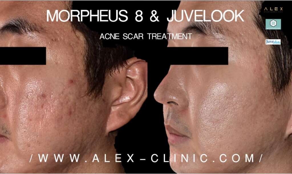 ผลลัพธ์หลังตัดพังผืดเลาะหลุมสิวร่วมกับฟื้นฟูเนื้อผิวหน้า Dr.Alex Clinic