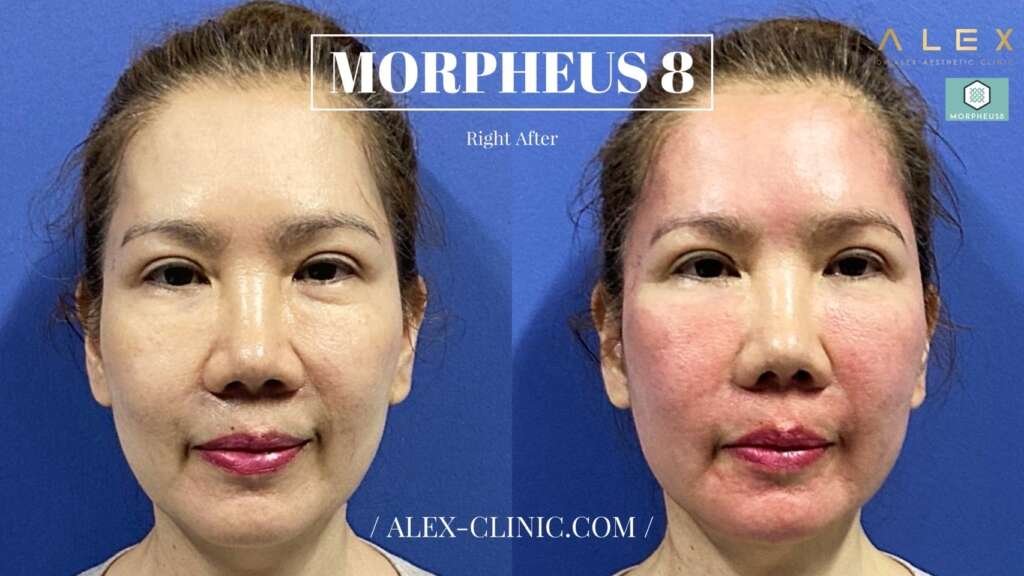 สภาพผิวหน้าทันทีหลังการรักษา แสดงรอยแดงชั่วคราวบนผิว
