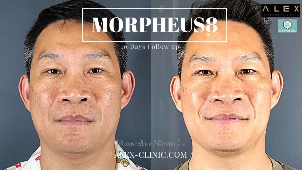สภาพผิวหน้าฟื้นตัวสมบูรณ์ รูขุมขนดูกระชับขึ้นหลังทำ 10 วัน