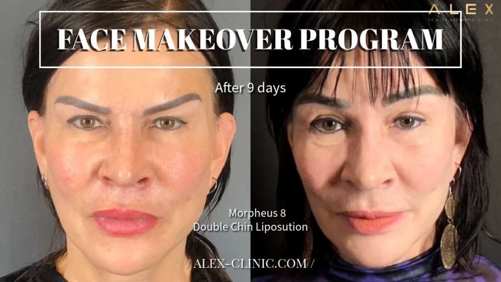 ภาพเปรียบเทียบก่อนหลังทำ Morpheus8 (M8) และดูดไขมันเหนียง มุมตรง Dr.Alex Clinic